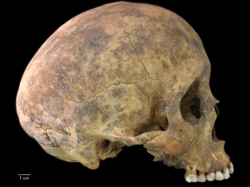 One of two cases of healed blows to the cranium from the Playa Venado excavation